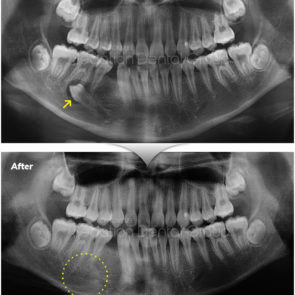 bna_sedation_dental_extraction_01