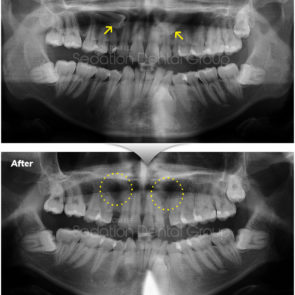 bna_sedation_dental_extraction_02