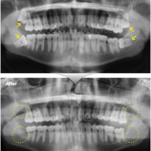 bna_sedation_dental_extraction_03