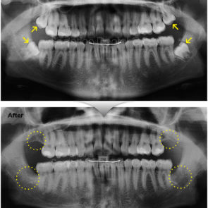 bna_sedation_dental_extraction_04