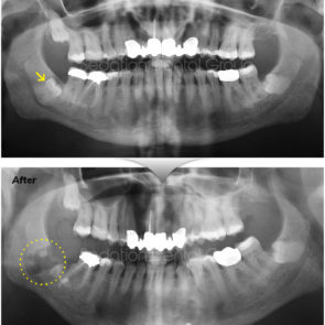 bna_sedation_dental_extraction_06