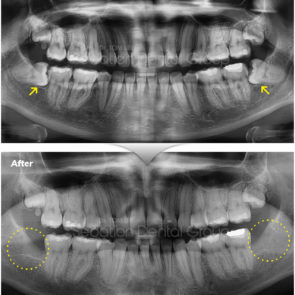 bna_sedation_dental_extraction_07