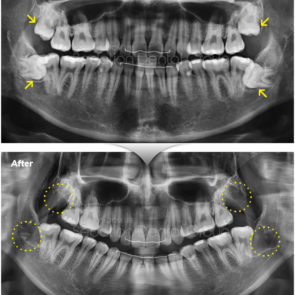 bna_sedation_dental_extraction_09
