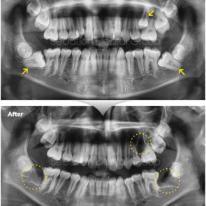 bna_sedation_dental_extraction_10
