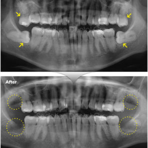 bna_sedation_dental_extraction_11