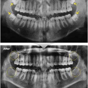 bna_sedation_dental_extraction_12