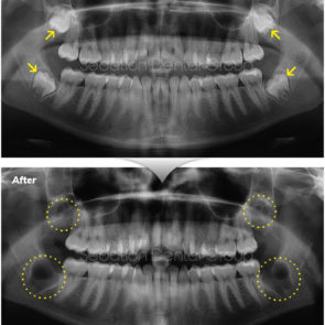 bna_sedation_dental_extraction_13