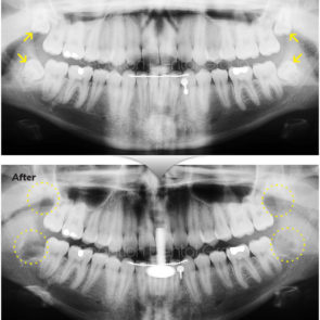 bna_sedation_dental_extraction_14