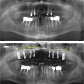 bna_sedation_dental_implant_001
