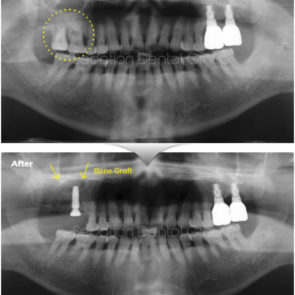 bna_sedation_dental_implant_002