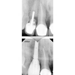 bna_sedation_dental_implant_003