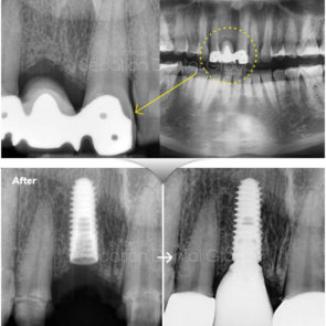 bna_sedation_dental_implant_004