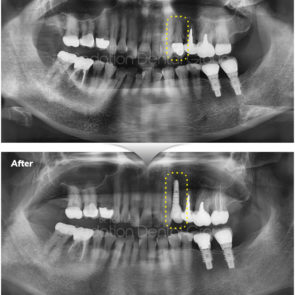 bna_sedation_dental_implant_005
