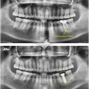 bna_sedation_dental_implant_006