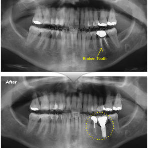 bna_sedation_dental_implant_007