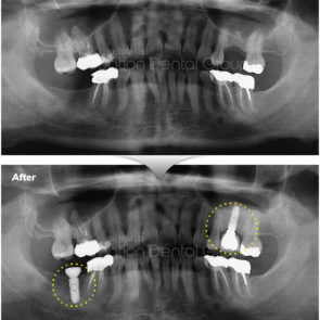 bna_sedation_dental_implant_008