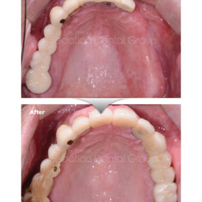bna_sedation_dental_implant_009