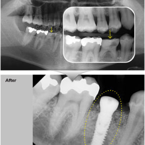 bna_sedation_dental_implant_012