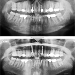 bna_sedation_dental_implant_013