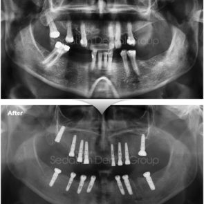 bna_sedation_dental_implant_014