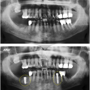 bna_sedation_dental_implant_015