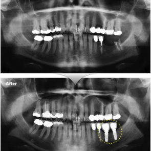 bna_sedation_dental_implant_017