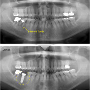 bna_sedation_dental_implant_018
