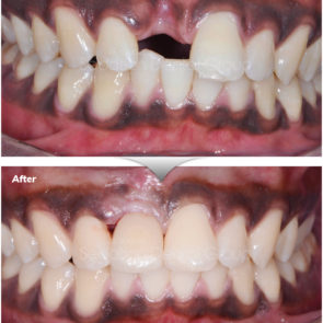 2019 Sedation_before n after_web_800x920_implant_18